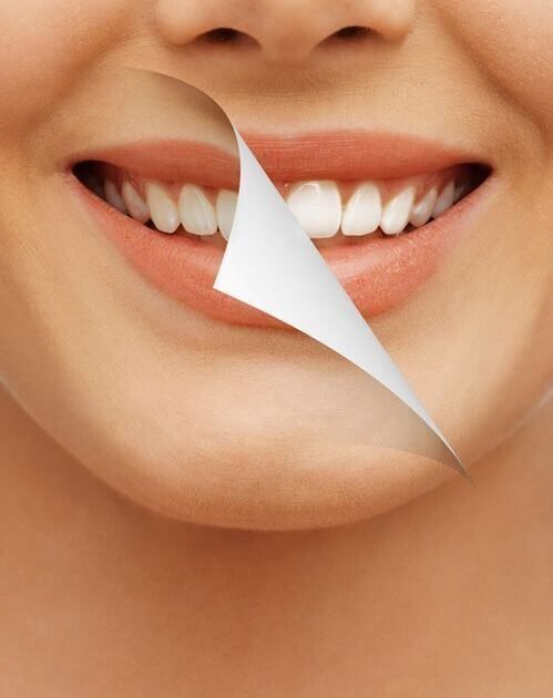 Teeth whitening